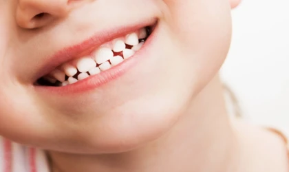 Dişler iyi temizlenmezse arayüz çürüğü oluşabiliyor